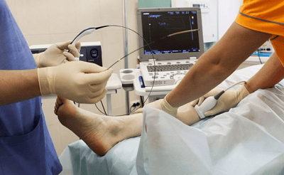 Endovenous Laser Ablation