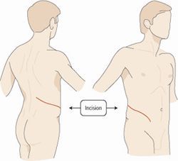 Laparoscopic Radical Nephrectomy