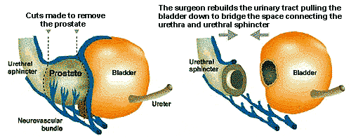 Radical Prostatectomy