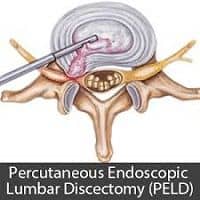 Percutaneous Endoscopic Lumbar Discectomy (PELD)