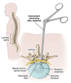 Require Percutaneous Endoscopic Lumbar Discectomy