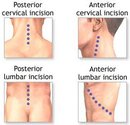 Scoliosis Surgery