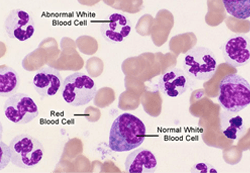 Types of Leukemia