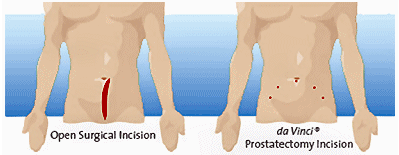 Radio Frequency Ablation