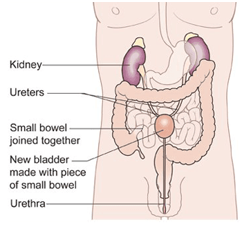 Radical Cystectomy