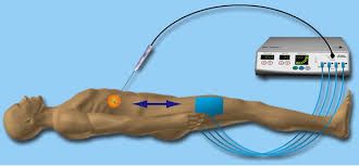 Radio Frequency Ablation for Liver Cancer