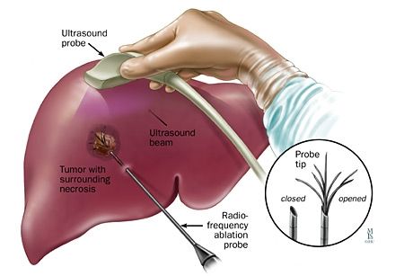 Radiofrequency ablation