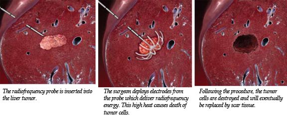 Radio Frequency Ablation for Liver Cancer - Viable and ...