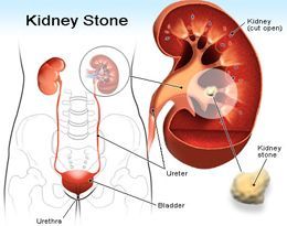 Percutaneous Nephrolithotomy (PCNL) Necessary