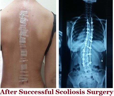 Adult Scoliosis Surgery and Correction Brace in Singapore