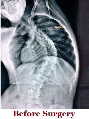 scoliosis