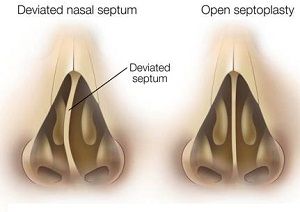 septorhinoplasty