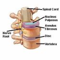 Cervical Disc Herniation