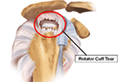 Bursitis or Tendinitis