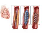 Treatment of Heart Diseases