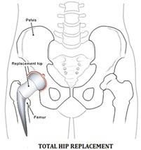 Total Hip Replacement Surgery (THR)