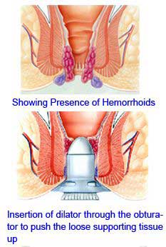 Procedure for Prolapse and Hemorrhoids