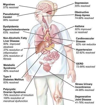 Endoscopic Options for Weight Loss