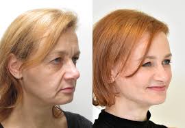 Face Lift surgery