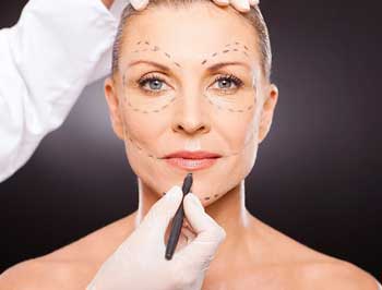 Face Lift surgery