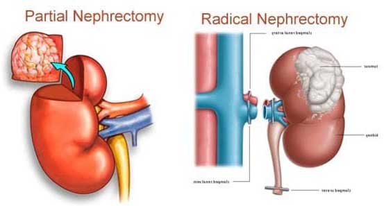 Laparoscopic Radical Nephrectomy