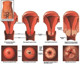 Types of Cervical cancer Treatment