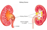 Kidney Stones