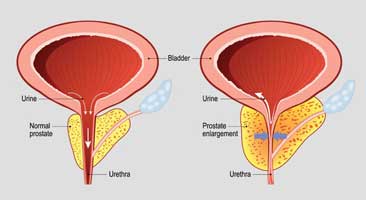 Treatments for Prostate Cancer