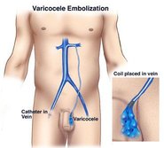 Laparoscopic Varicocelectomy