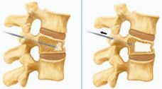 Osteoportic Vertebral Fracture