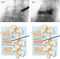 Vertebroplasty and Kyphoplasty