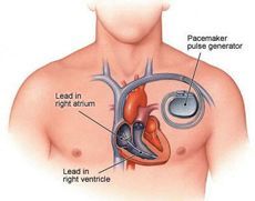 What is a Pacemaker