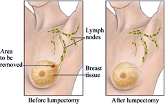 Breast Conservation Surgery