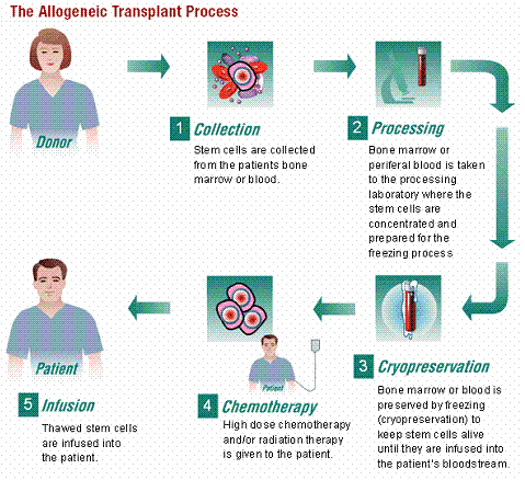 allogeneic bone marrow transplant