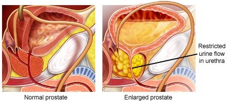  What is Prostate Cancer- Symptoms & Treatment Options at World Class Hospitals in India