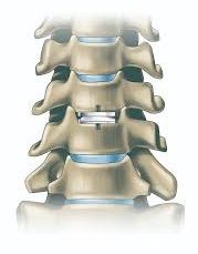 Cervical Disc Replacement