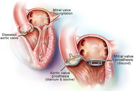  Non Surgical Heart Valve Replacement at SafeMedTrip.com affiliated hospitals in India provide a ray of hope to heart patients