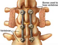  Spinal Fusion Surgery- Advanced minimally invasive treatment  at world class hospital in India promises a pain free future to patients suffering from chronic lower back pain.