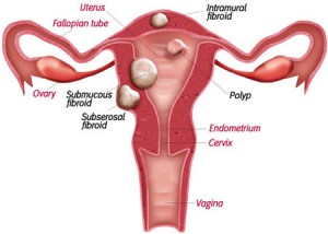  Most Advanced Uterine Cancer Treatment at World-class Hospitals in India