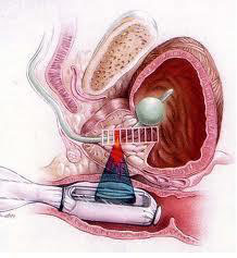  High-intensity focused ultrasound (HIFU)  for Prostate Cancer