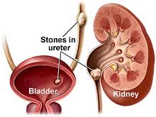  Non-Surgical Treatment for Urinary Stones at World Class Hospitals in India
