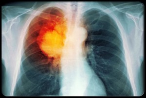  Lung Cancer Treatment at SafeMedTrip Affiliated Best Cancer Hospitals in India
