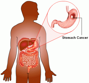  Most Advanced Stomach Cancer Treatment at World-class Hospitals in India
