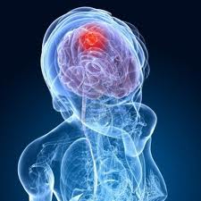  Advantages of Next Generation Technology over Conventional Neurosurgery to Remove Brain Tumor – MRI Guided Brain Tumor Surgery