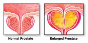  Highly Advanced Minimally Invasive Laser Prostate treatments for prostate enlargement (BPH)