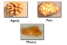  Minimally Invasive Surgeries for Kidney stone in India – no pain, no cuts.