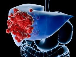  What’s New Research and Treatment for Liver Cancer