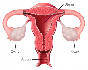 Ovarian cancer