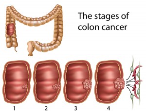  Risk Factors for Colon Cancer – Colon Cancer  Treatment in India