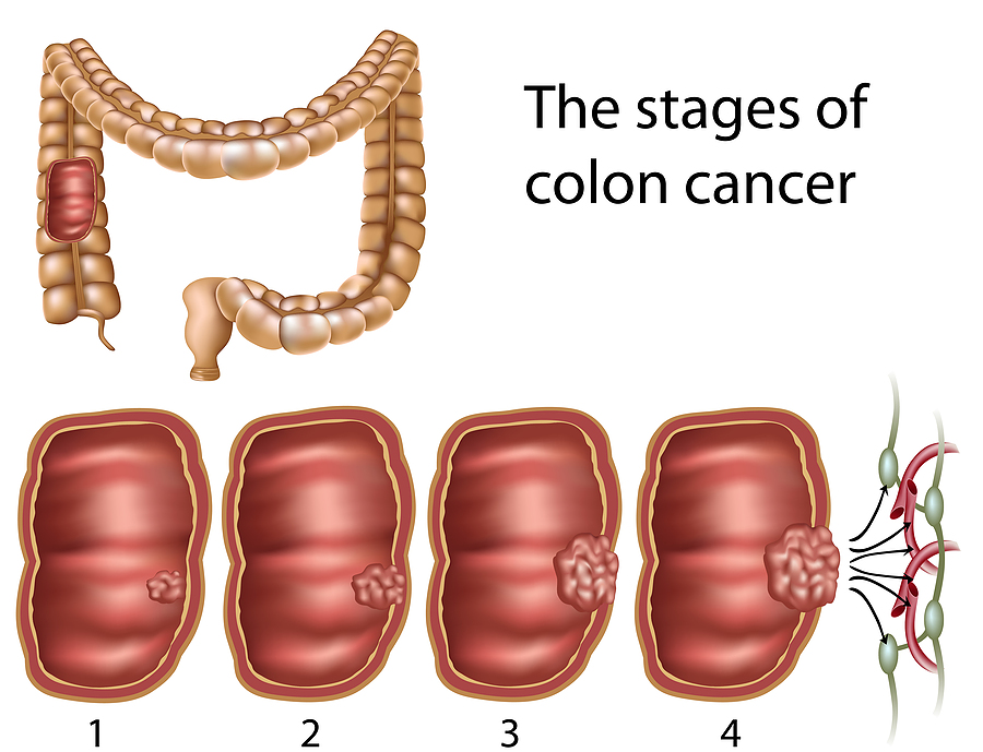 cancer de colon fases